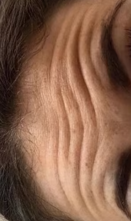 Antes - Imagen antes