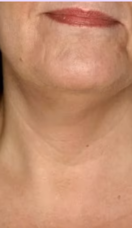 Antes - Imagen antes