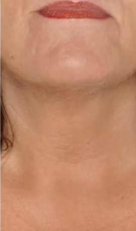 Después - Imagen después