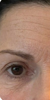 Antes - Imagen antes